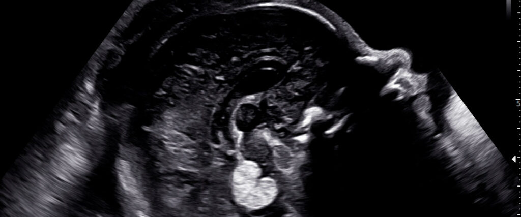Ultrassom morfológico mostrando o perfil fetal em corte sagital.
