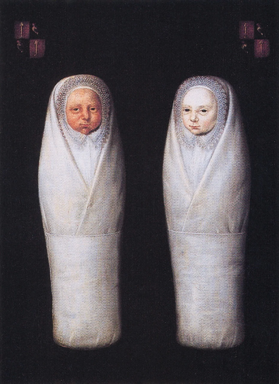De Wikkelkinderen, pintura holandesa de 1617 mostrando dois recém-nascidos gêmeos com colorações opostas — um vermelho e outro pálido — possível caso de TAPS ou transfusão feto-fetal