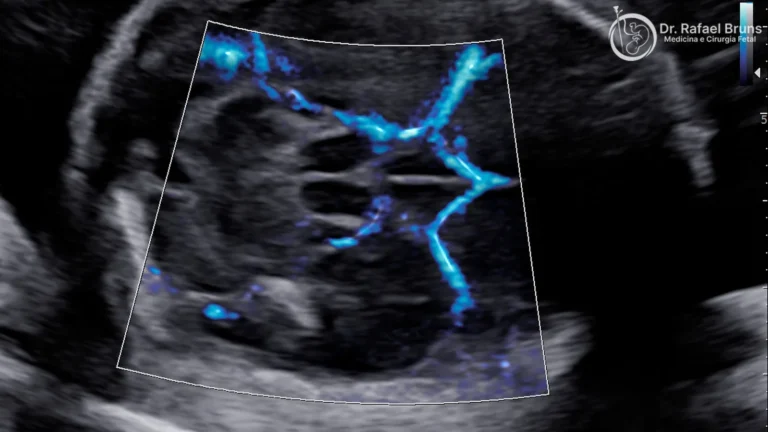 Ultrassom Doppler colorido mostrando fluxo sanguíneo placentário