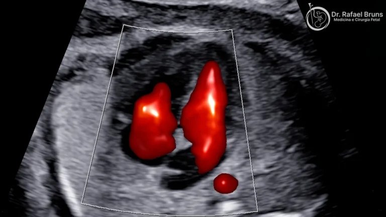 Ecocardiografia fetal com Doppler colorido mostrando fluxo sanguíneo no coração do bebê
