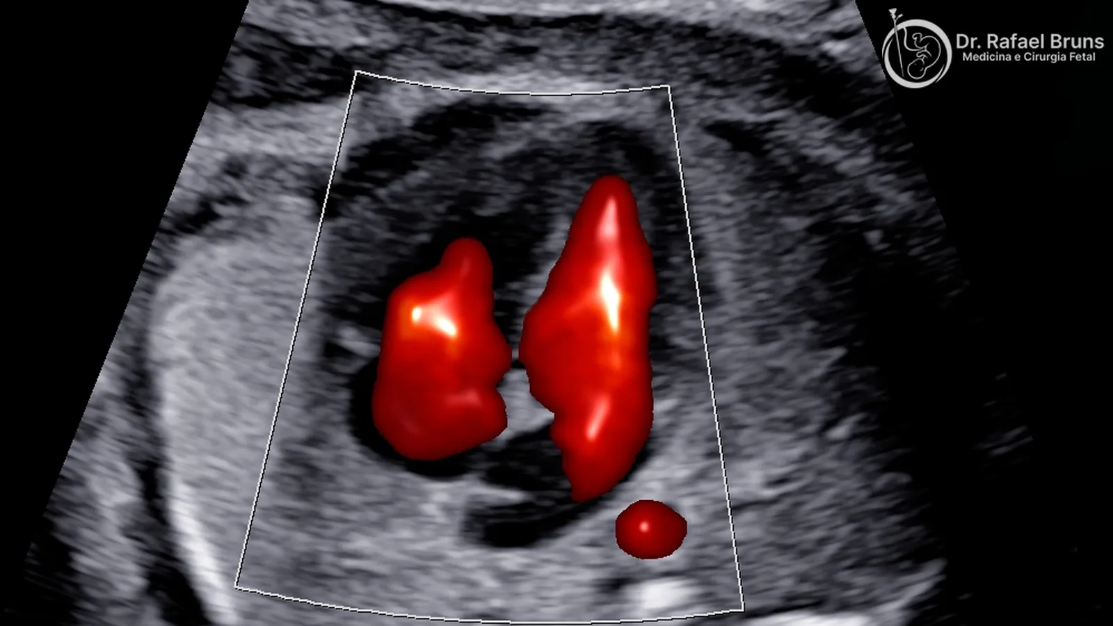 Ecocardiografia fetal: quando é indicada e o que avalia
