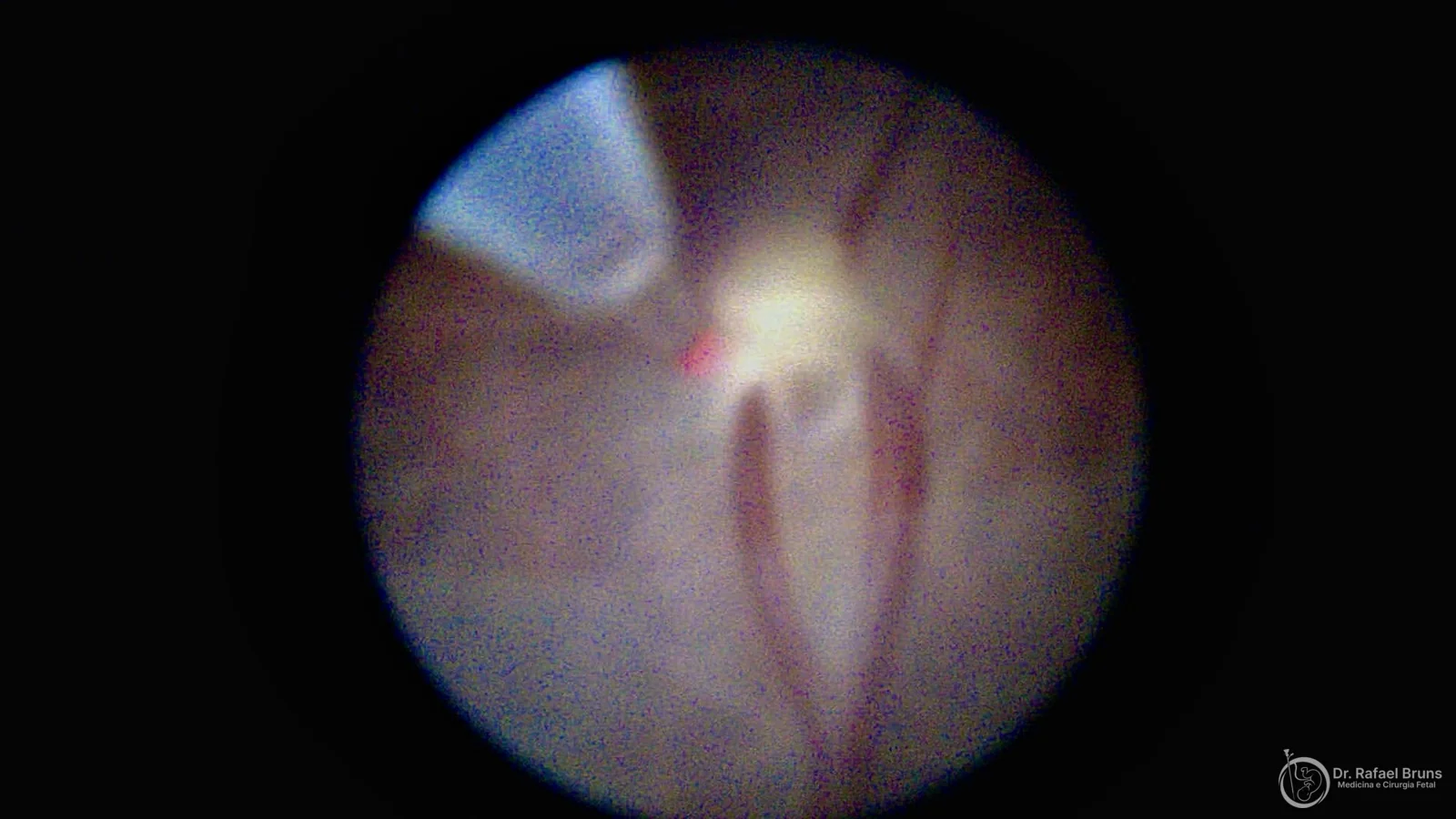 Imagem fetoscópica de anastomose placentária após ablação a laser durante cirurgia fetal para tratamento da síndrome de transfusão feto-fetal — acervo Dr. Rafael Bruns