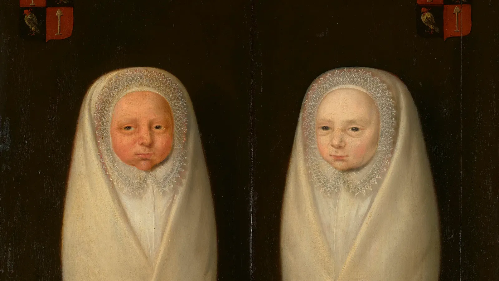 Da Bíblia ao laser: a história da síndrome de transfusão feto-fetal