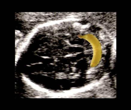 Sinal da banana no ultrassom — cerebelo com formato curvo característico da mielomeningocele