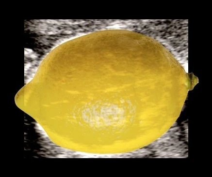 Sinal do limão no ultrassom — crânio fetal com formato de limão característico da mielomeningocele