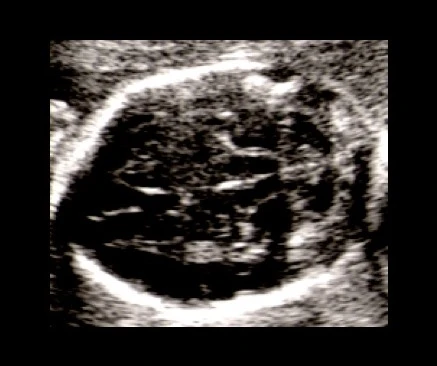 Ultrassom do crânio fetal em caso de mielomeningocele