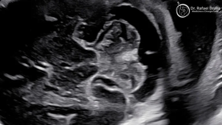 Neurosonografia fetal mostrando a fossa posterior com cerebelo e cisterna magna do feto