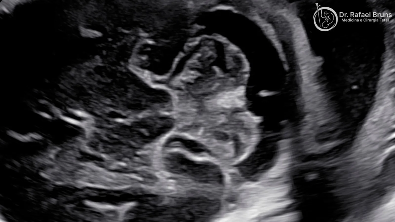 Neurossonografia fetal: quando é indicada e o que o exame avalia