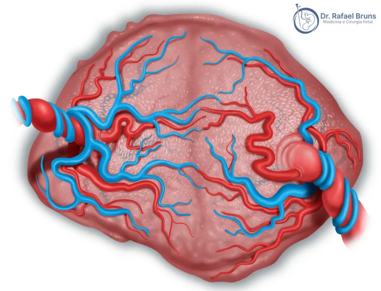 Ilustração de placenta monocoriônica mostrando anastomoses arteriovenosas entre os territórios dos gêmeos na síndrome da transfusão feto-fetal