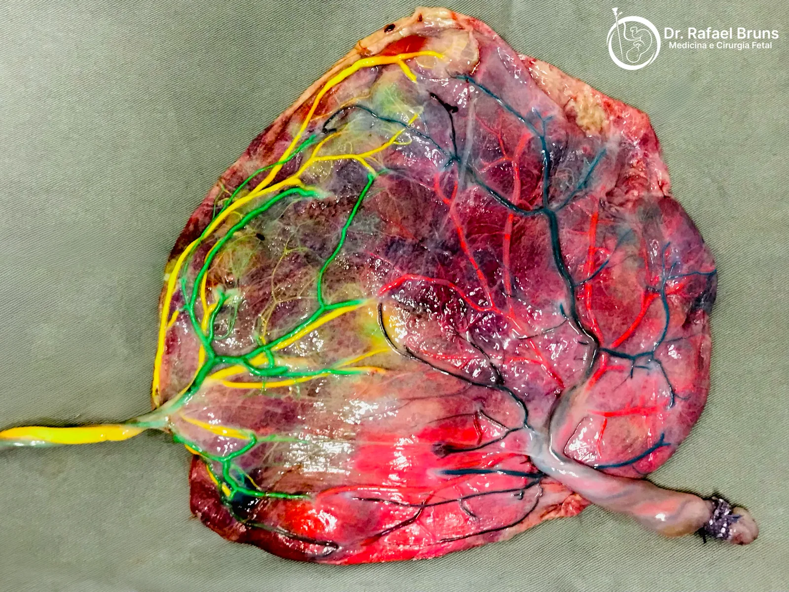 Placenta monocoriônica injetada mostrando anastomoses vasculares entre os territórios dos dois fetos