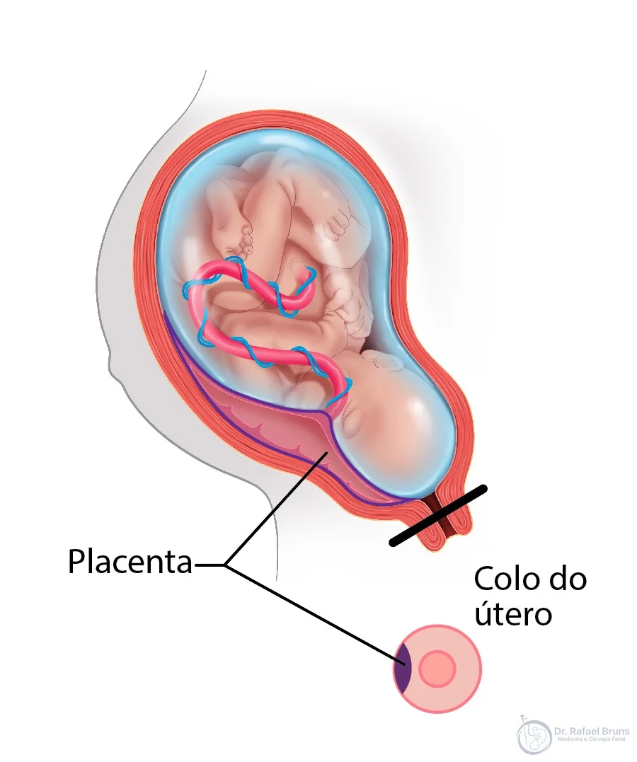 Ilustração de placenta prévia marginal — borda da placenta tangencia o orifício interno do colo