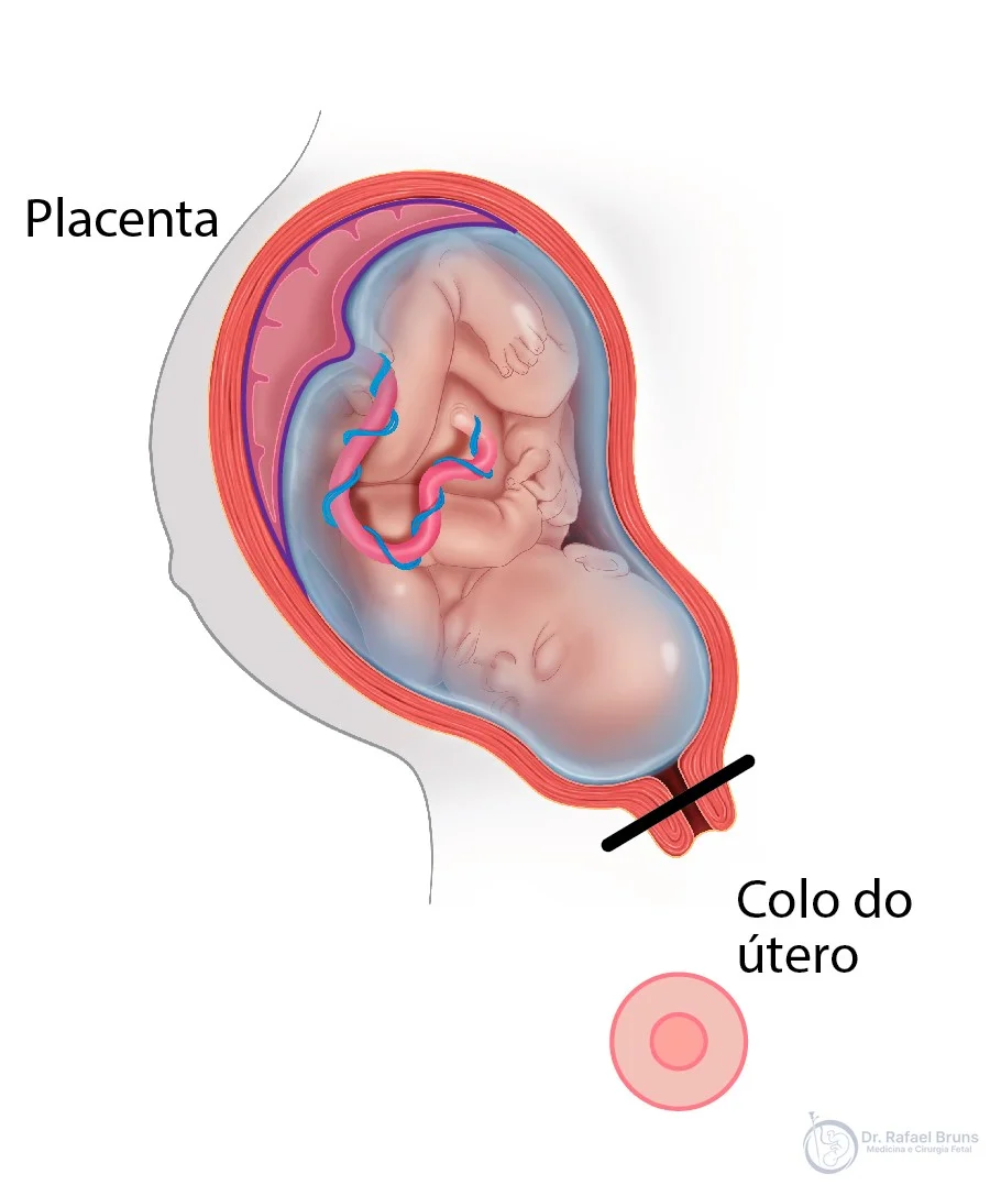 Ilustração da posição normal da placenta — placenta implantada no fundo uterino, longe do colo