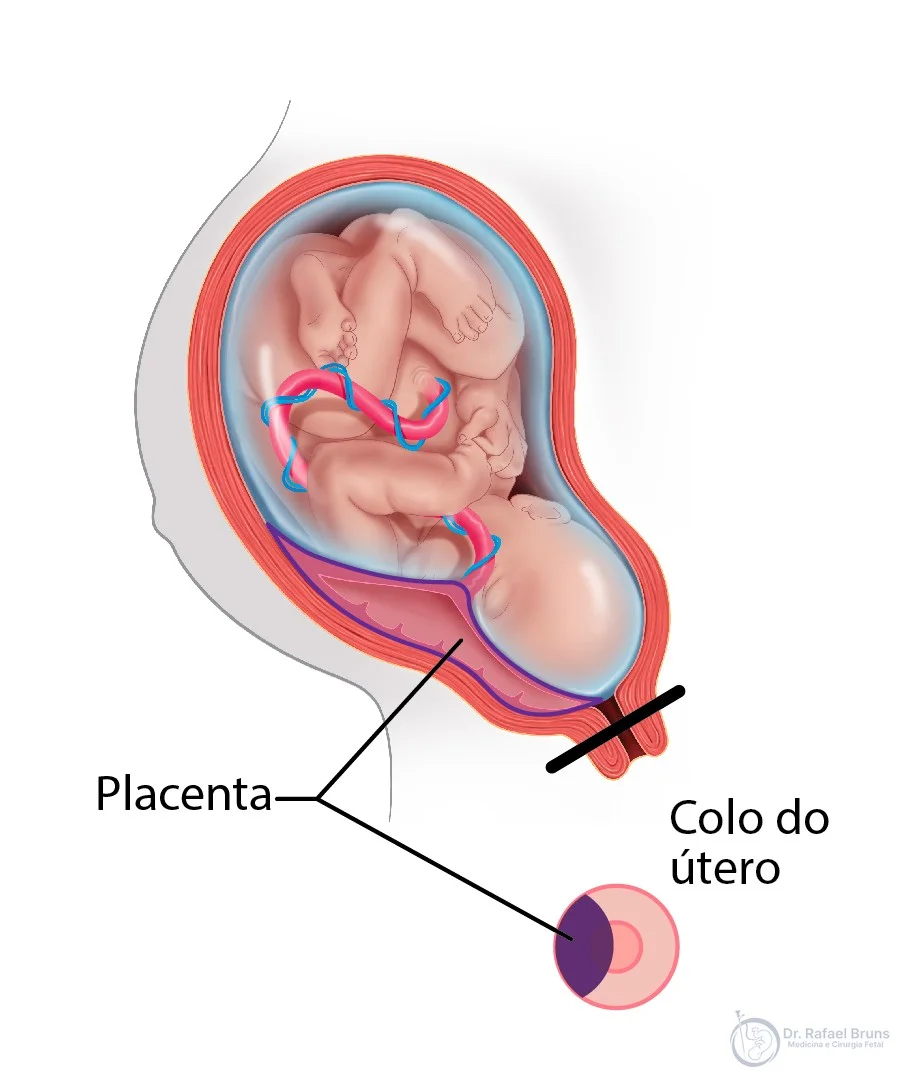 Ilustração de placenta prévia parcial — placenta cobre parcialmente o orifício interno do colo uterino