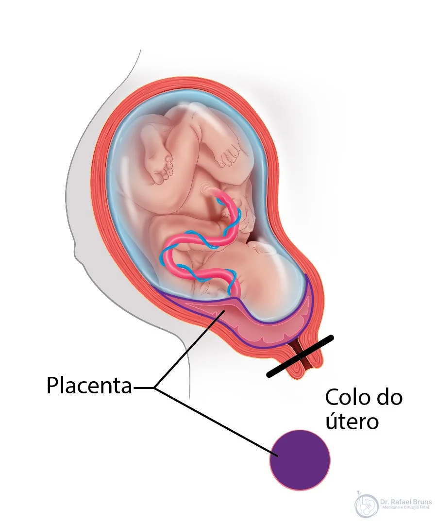 Ilustração de placenta prévia total — placenta cobre completamente o orifício interno do colo uterino