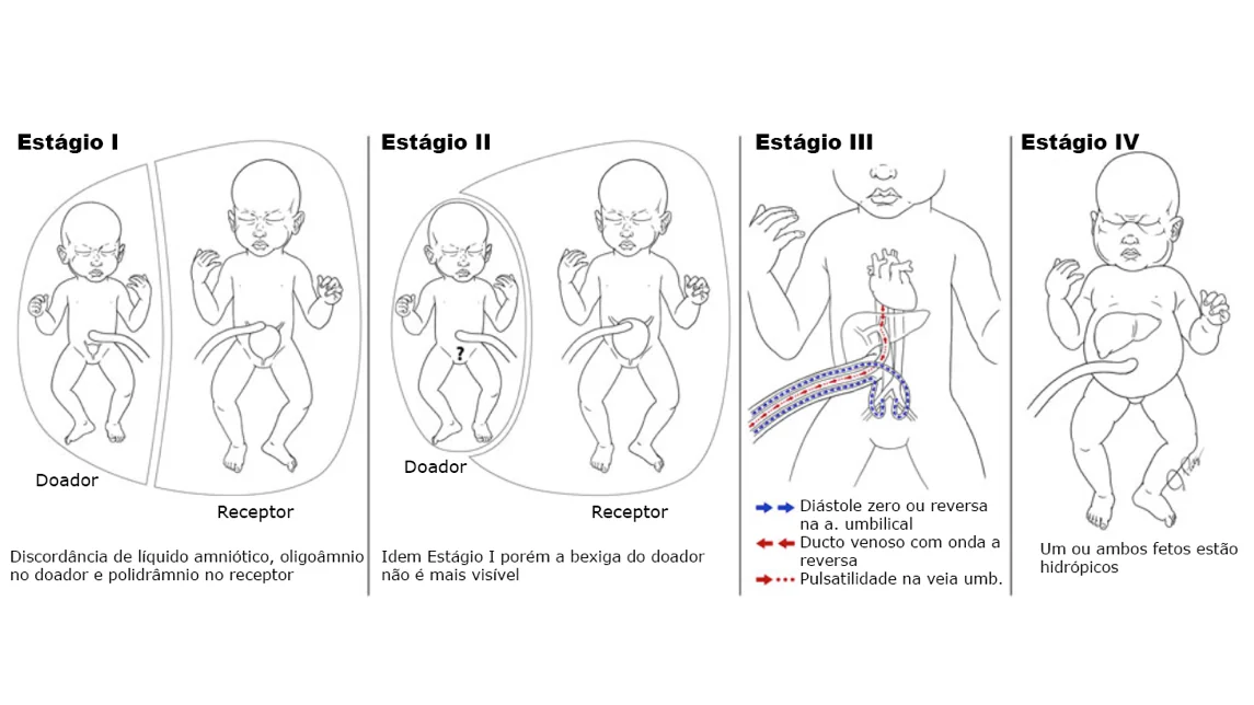 Tabela resumo dos cinco estágios da classificação de Quintero para síndrome de transfusão feto-fetal com critérios diagnósticos e conduta por estágio