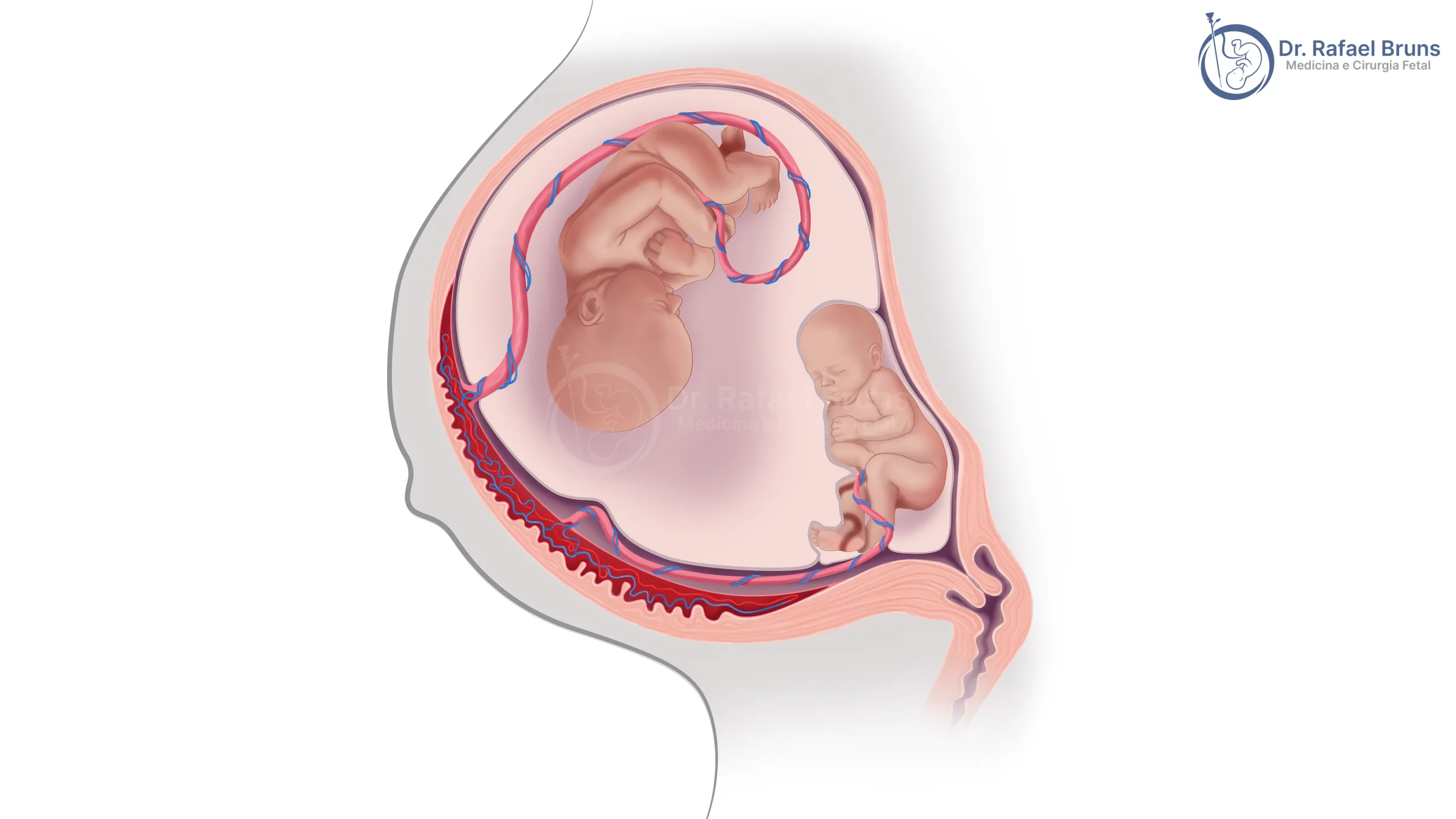 Ilustração da síndrome da transfusão feto-fetal mostrando gêmeos monocoriônicos com circulação placentária compartilhada