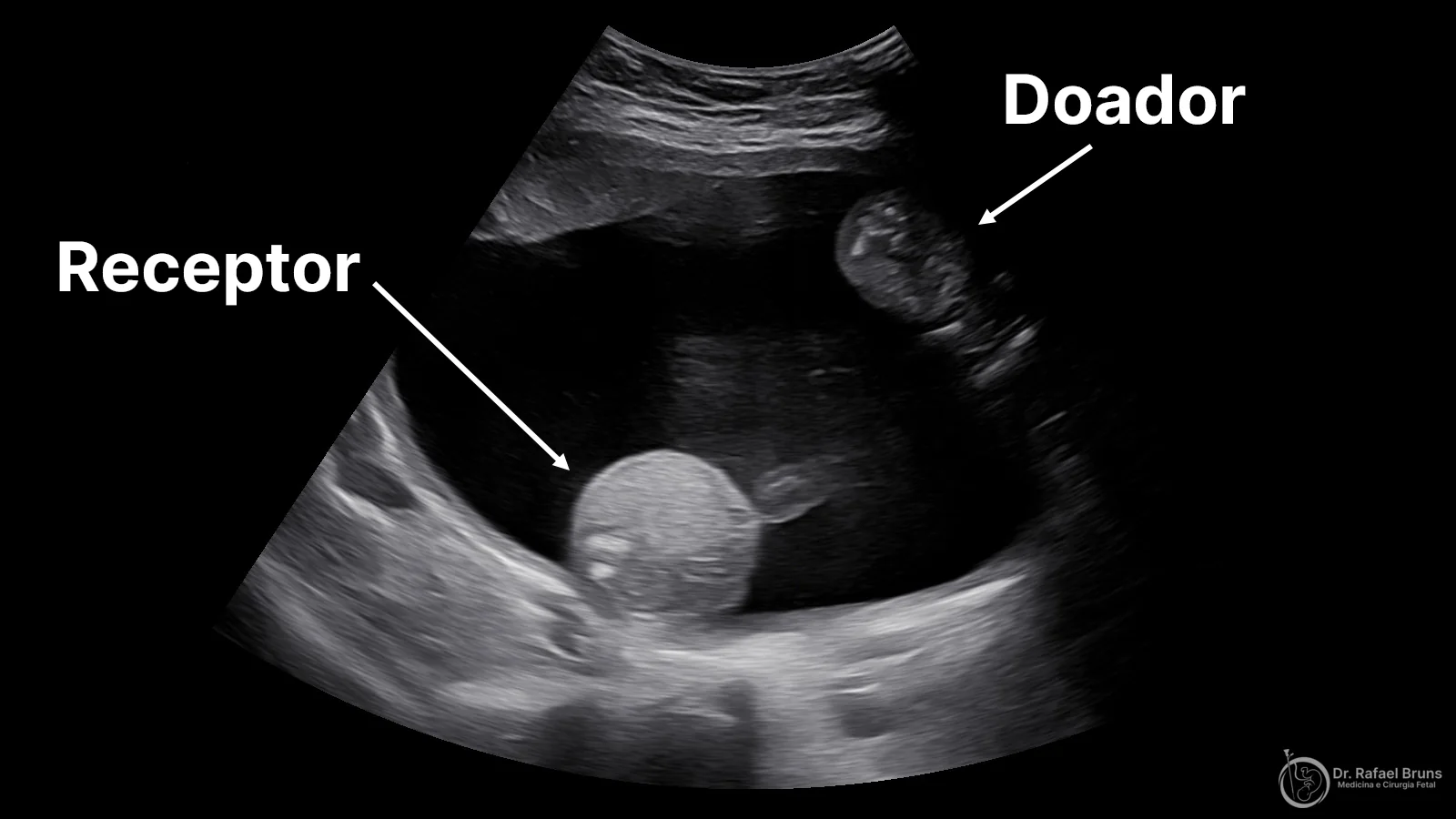 Ultrassonografia de síndrome de transfusão feto-fetal mostrando feto receptor com polidrâmnio e feto doador comprimido como stuck twin na parede anterior