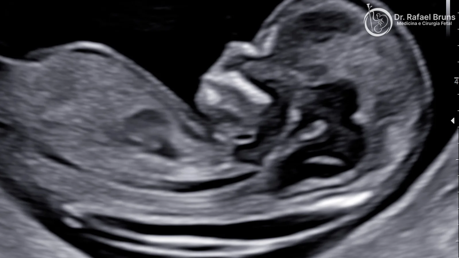 Ultrassom de translucência nucal no primeiro trimestre de gestação