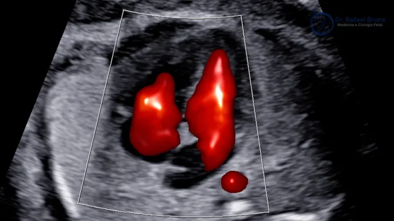 Ultrassom morfológico com Doppler colorido do coração fetal durante avaliação de segundo trimestre