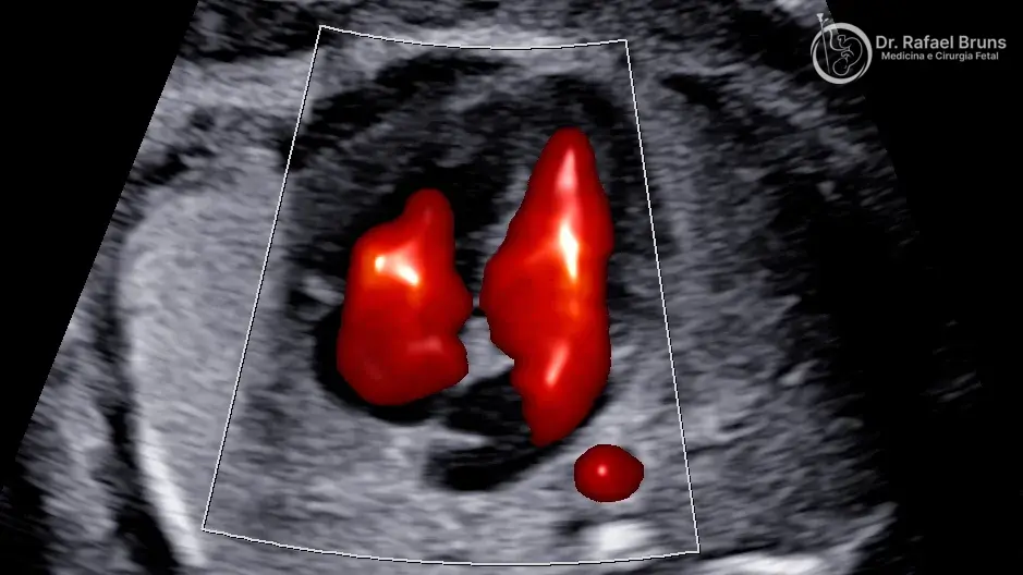 Ultrassom morfológico do segundo trimestre: o que avalia, o que detecta e o que ainda pode passar