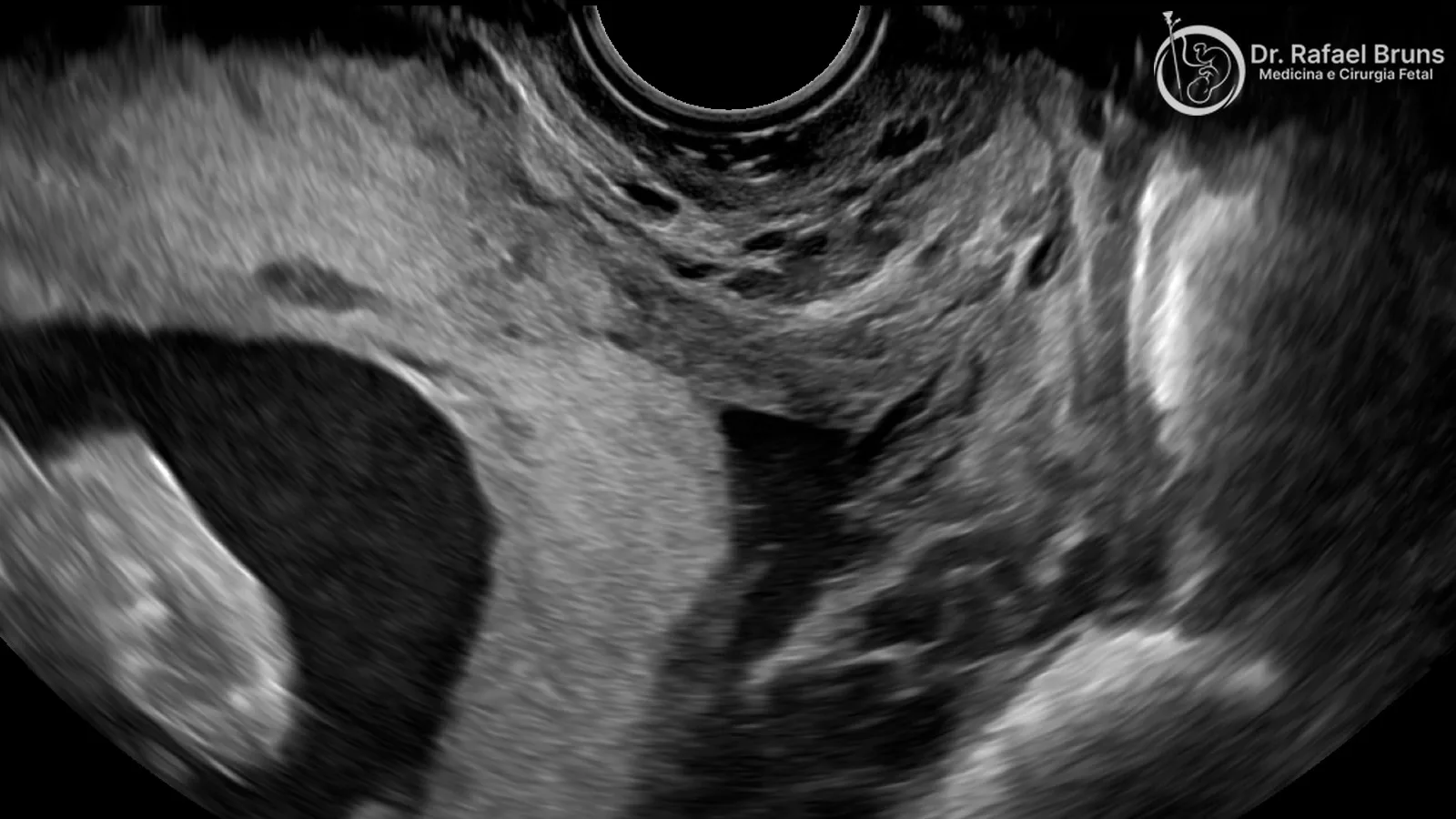 Ultrassom transvaginal mostrando placenta prévia — a placenta cobre o orifício interno do colo uterino