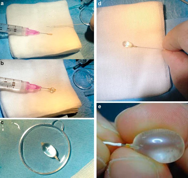 Balão Goldbal 2 em cinco etapas: do dispositivo vazio montado na agulha até inflado no microcateter, com dedos ao lado mostrando a escala real do balão utilizado na oclusão traqueal fetal