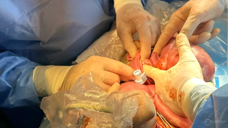 Procedimento EXIT sendo realizado por equipe multidisciplinar — cirurgia fetal para garantir a via aérea do bebê com obstrução por tumor cervical ou CHAOS, antes do nascimento