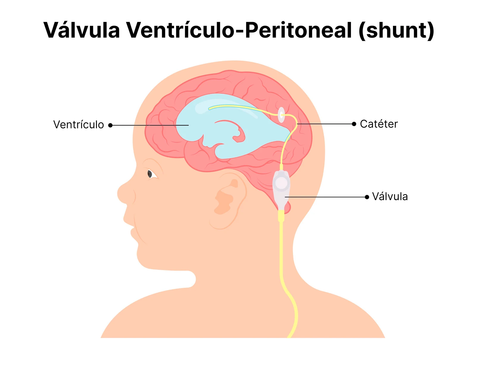 Desenho esquemático de uma derivação ventrículo-peritoneal mostrando o ventrículo cerebral dilatado, o cateter e a válvula que drena o líquido cefalorraquidiano para a cavidade abdominal