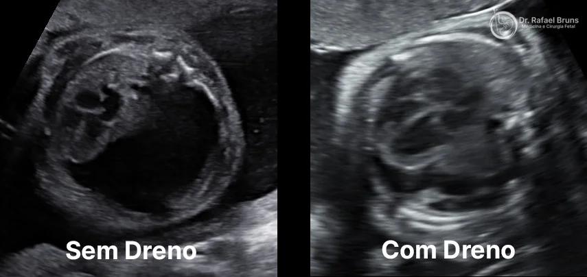 Comparação ultrassonográfica do tórax fetal antes e depois da colocação do shunt toracoamniótico — à esquerda, sem dreno, grande volume de líquido pleural com desvio do mediastino e compressão do coração; à direita, com dreno, redução significativa do derrame e descompressão cardíaca