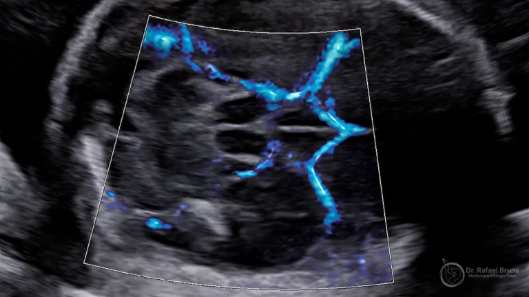 Doppler colorido da artéria cerebral média fetal mostrando o Polígono de Willis — exame utilizado para monitoramento não invasivo de anemia fetal