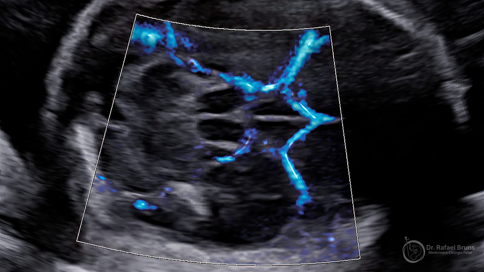 Doppler colorido da artéria cerebral média fetal mostrando o Polígono de Willis — exame utilizado para monitoramento não invasivo de anemia fetal