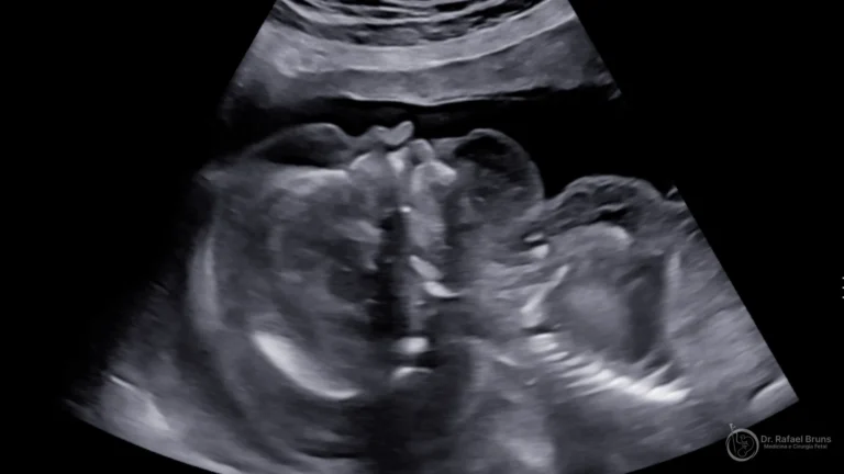 Ultrassom mostrando feto com hidropsia fetal — edema subcutâneo, derrame pleural e ascite — acervo Dr. Rafael Bruns