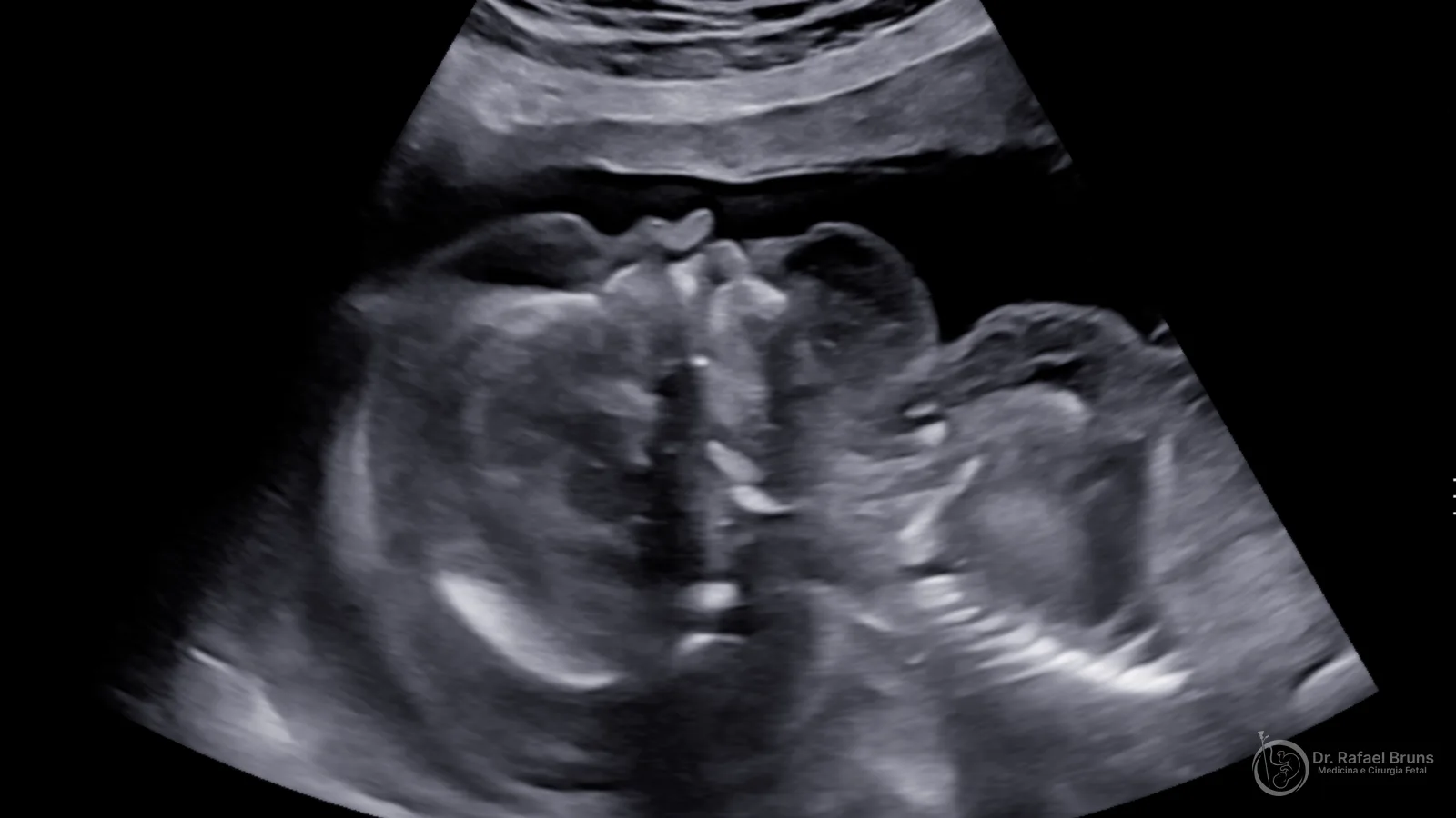 Hidropsia Fetal: causas, diagnóstico e tratamento