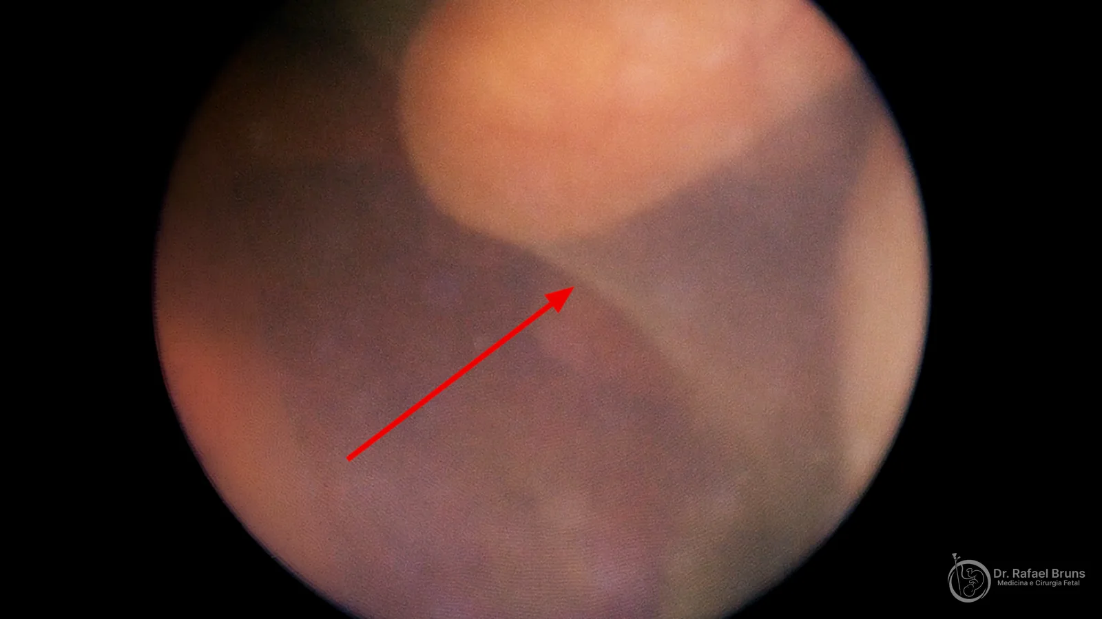 Imagem de fetoscopia mostrando a membrana amniótica do feto doador justaposta ao corpo em um caso de stuck twin na síndrome de transfusão feto-fetal — acervo Dr. Rafael Bruns