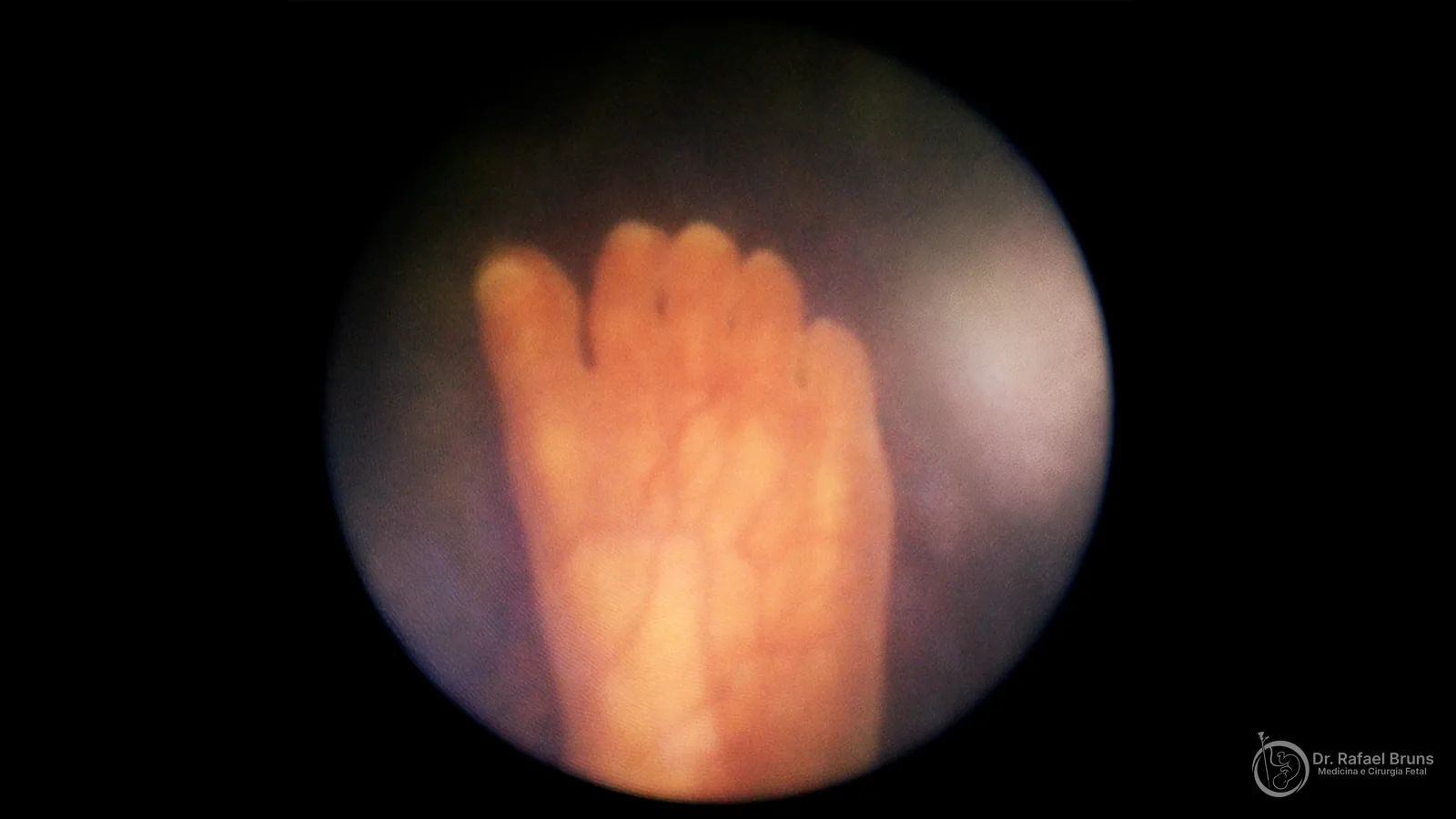 Pé de feto de 19 semanas de gestação visualizado por fetoscopia durante cirurgia a laser para tratamento da síndrome de transfusão feto-fetal — acervo Dr. Rafael Bruns