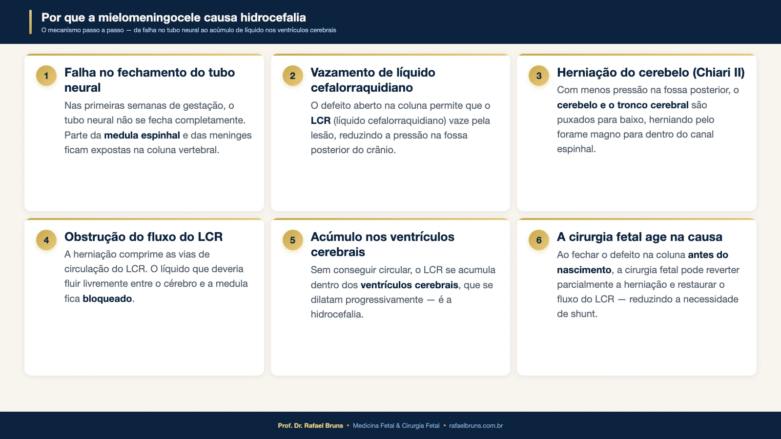 Infográfico explicando em seis etapas o mecanismo pelo qual a mielomeningocele leva à hidrocefalia fetal
