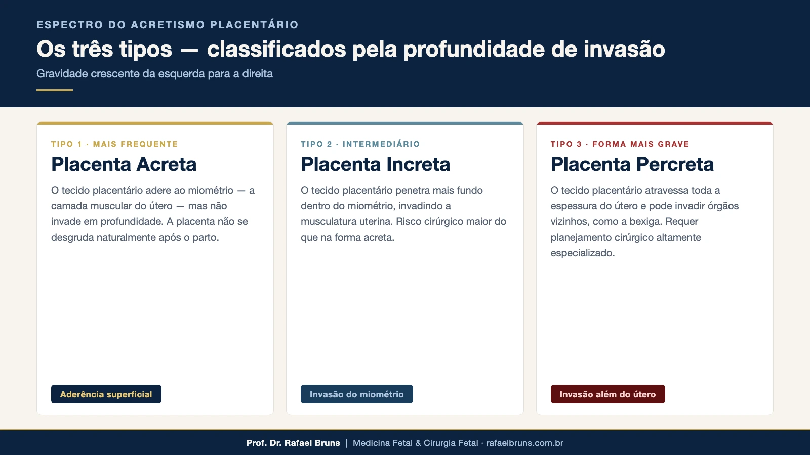 Infográfico comparativo dos três tipos de acretismo placentário: acreta com aderência superficial, increta com invasão do miométrio, e percreta com invasão além da serosa uterina