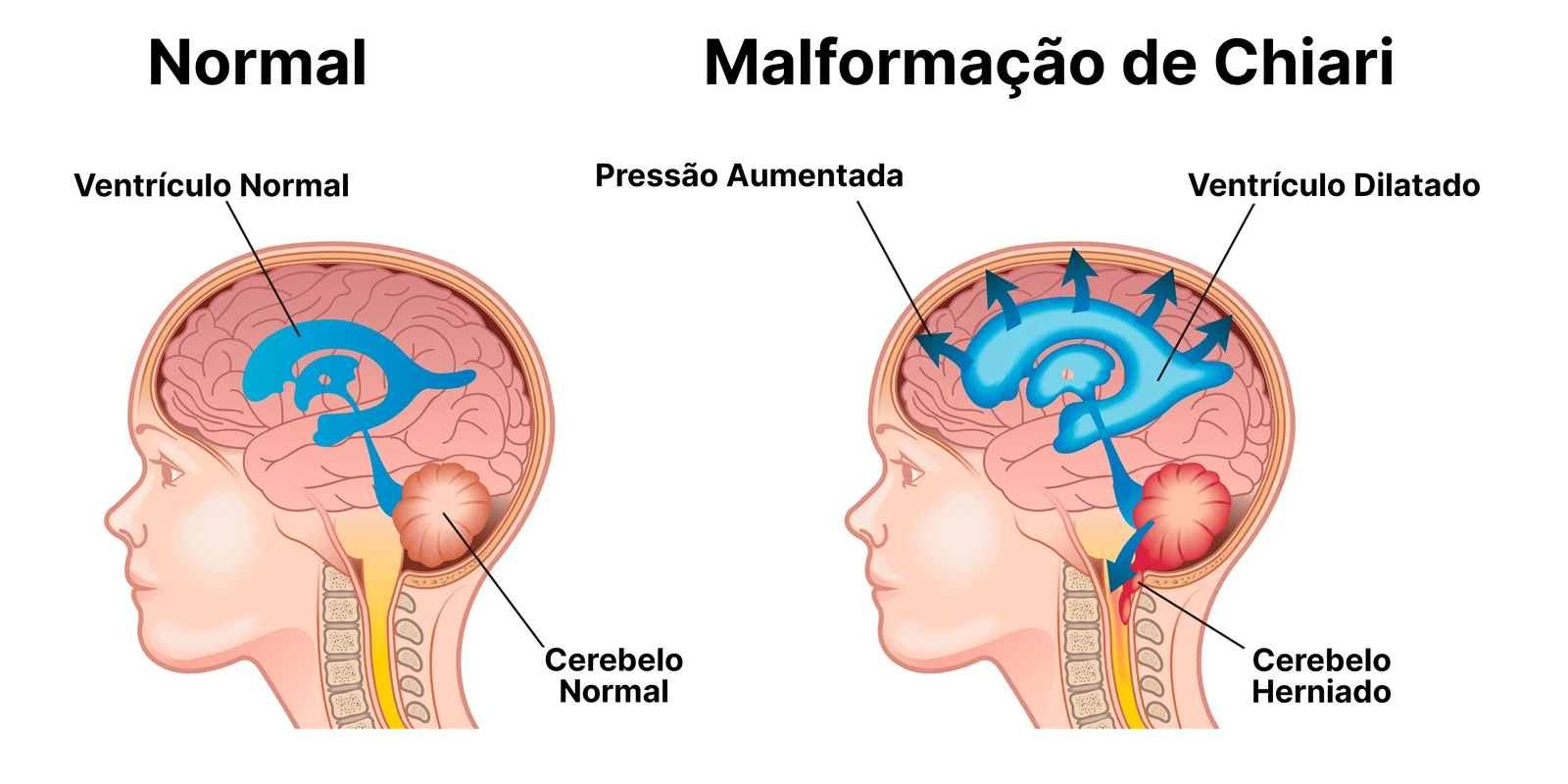 Comparação entre criança com anatomia cerebral normal (esquerda) e criança com malformação de Chiari tipo II na mielomeningocele (direita), mostrando herniação do cerebelo e dilatação dos ventrículos laterais