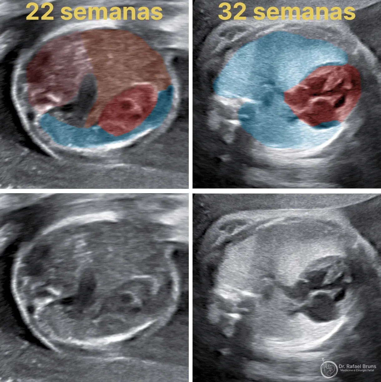 Ultrassonografia antes e depois da oclusão traqueal fetal em caso de hérnia diafragmática congênita: à esquerda vísceras abdominais no tórax com 22 semanas, à direita pulmões expandidos após o procedimento FETO