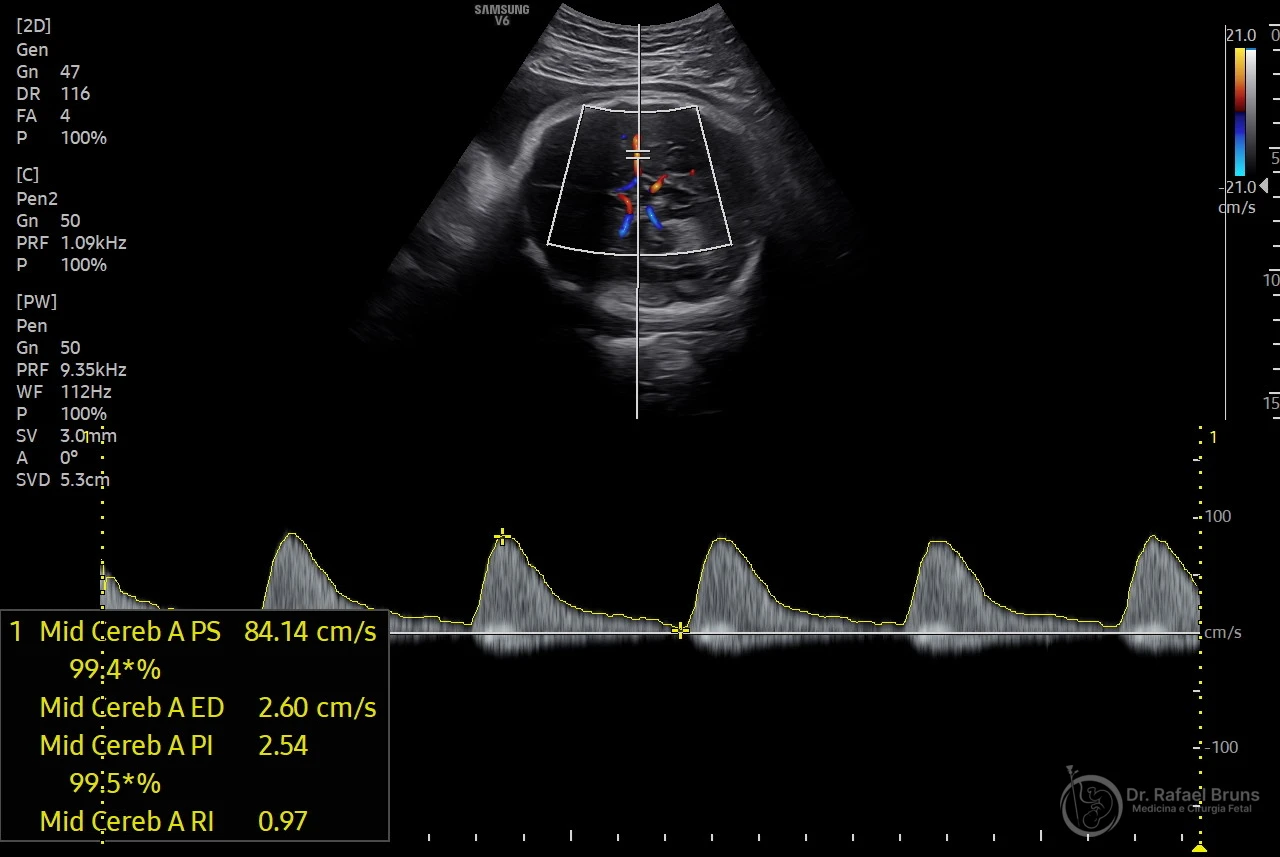 Doppler da artéria cerebral média fetal mostrando pico de velocidade sistólica de 84 cm/s em feto de 35 semanas — valor de 1,67 MoM acima do limiar de 1,5 MoM, sugerindo anemia fetal moderada a grave