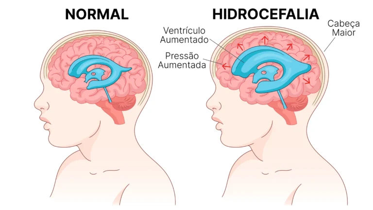 Ultrassom fetal comparando ventrículos cerebrais normais com hidrocefalia: à esquerda, ventrículos de tamanho normal; à direita, dilatação ventricular característica da ventriculomegalia fetal