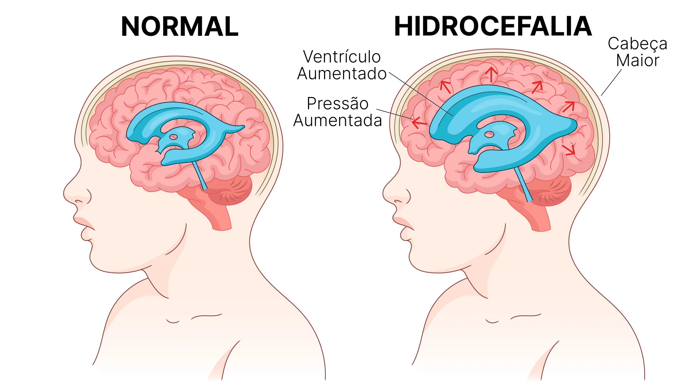 Hidrocefalia fetal: o que significa o laudo e o que fazer agora