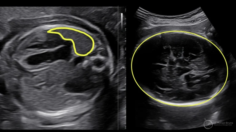 Ultrassom fetal mostrando a medição do LHR na hérnia diafragmática congênita: à esquerda, a área do pulmão contralateral; à direita, a circunferência cefálica