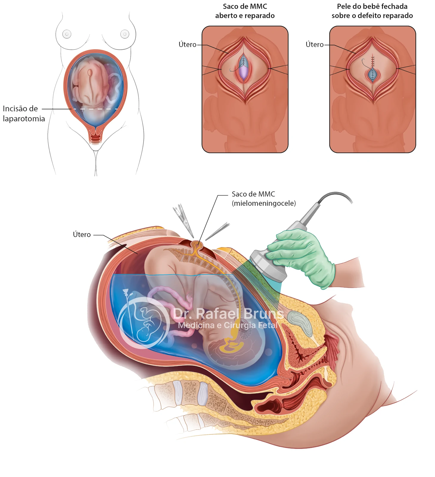Esquema anatômico da cirurgia fetal aberta para mielomeningocele: histerotomia, exposição do feto e reparo direto do defeito da medula