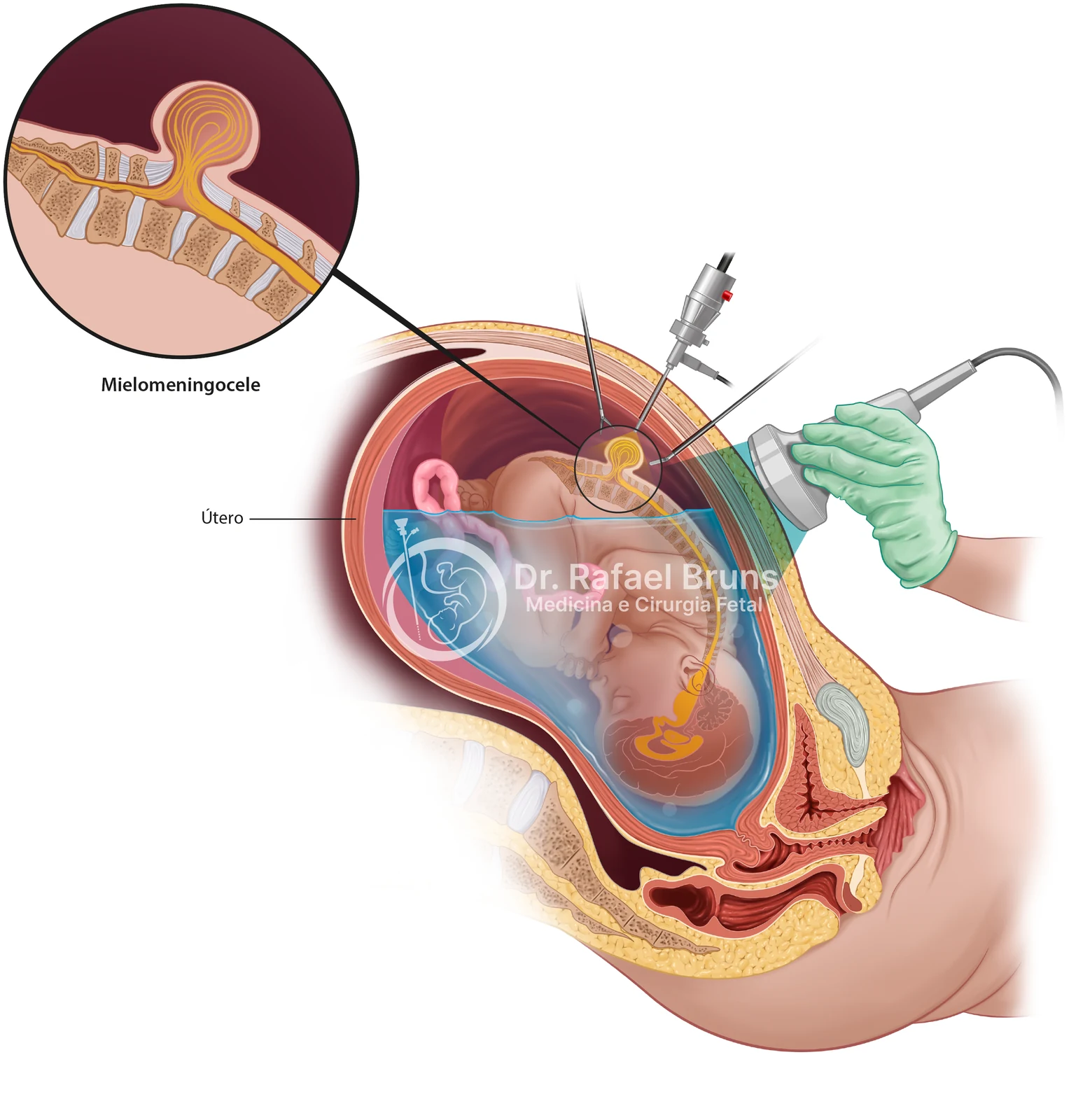 Esquema anatômico da cirurgia fetal fetoscópica para mielomeningocele: trocartes percutâneos no útero e correção endoscópica do defeito