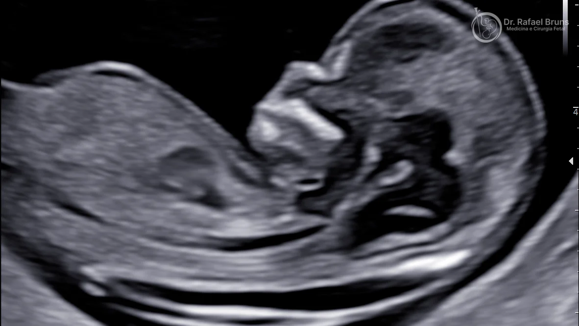 Ultrassom de feto em corte sagital no morfológico de primeiro trimestre — perfil fetal entre 11 e 13 semanas e 6 dias, momento ideal para avaliação da translucência nucal, osso nasal e anatomia precoce