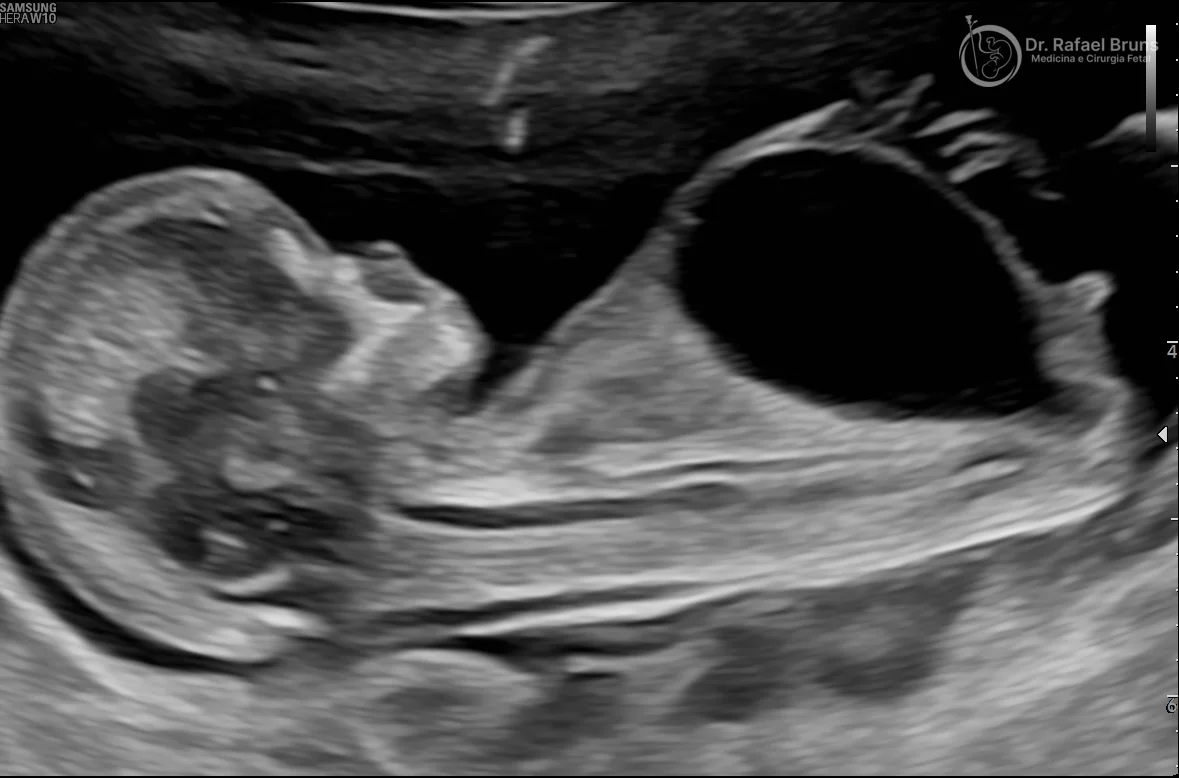 Ultrassom de feto com megabexiga (bexiga distendida) sugestiva de válvula de uretra posterior — sinal característico de obstrução urinária fetal