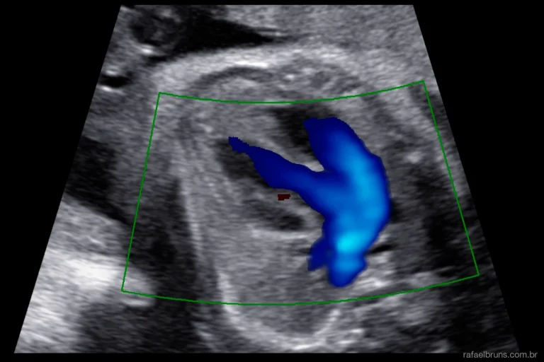 Ecografia mostrando avaliação cardíaca fetal com Doppler colorido em caso de transposição das grandes artérias durante ultrassom morfológico