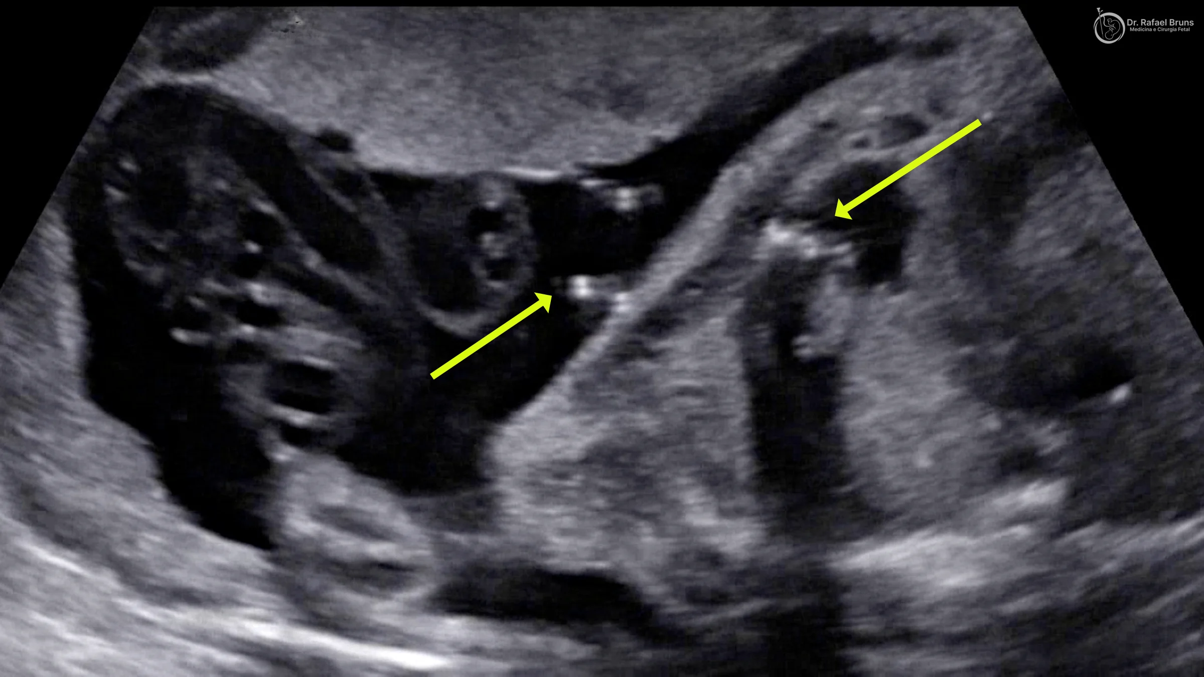 Ultrassom obstétrico de feto com aproximadamente 28 semanas mostrando o shunt toracoamniótico em posição, com setas amarelas indicando as duas extremidades do dreno — uma na cavidade pleural do bebê e outra no líquido amniótico