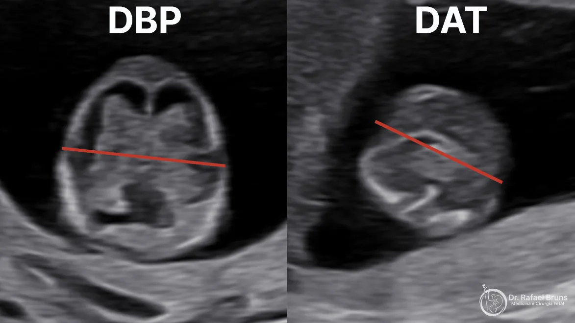 Duas imagens de ultrassom lado a lado: à esquerda, a medida do diâmetro biparietal em corte axial da cabeça fetal; à direita, a medida do diâmetro abdominal transverso em corte axial do abdome fetal, ambas com a linha de medida em vermelho